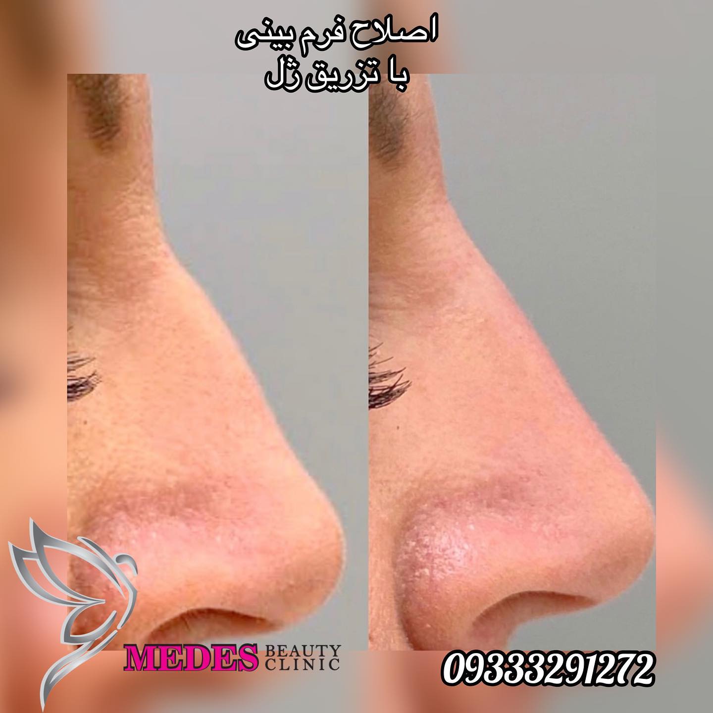 گالری اصلاح فرم بینی